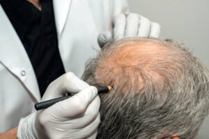 Scalp Micropigmentation 