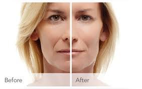 Dermal Fillers Injections in Abu Dhabi