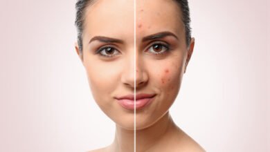 Acne Scar Removal Singapore