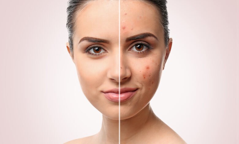 Acne Scar Removal Singapore