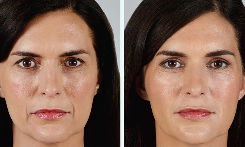 Juvederm Treatment