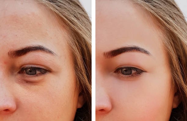 Dark Circles treatment in Abu Dhabi