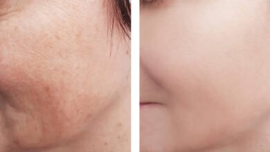 Pigmentation Treatment in Abu Dhabi