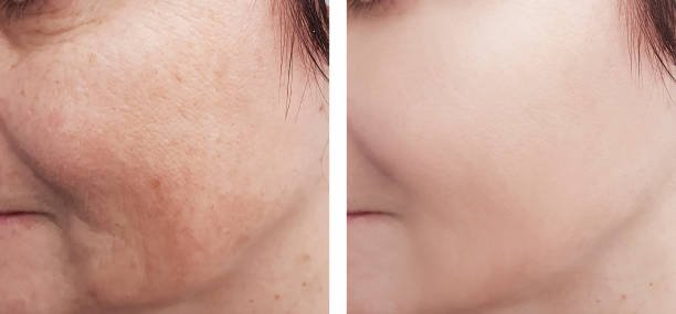 Pigmentation Treatment in Abu Dhabi