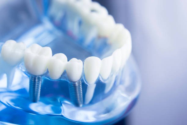 Root Canal Treatment Cost in Abu Dhabi