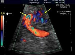 Doppler ultrasound