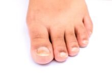 podiatrist and ingrown toenail