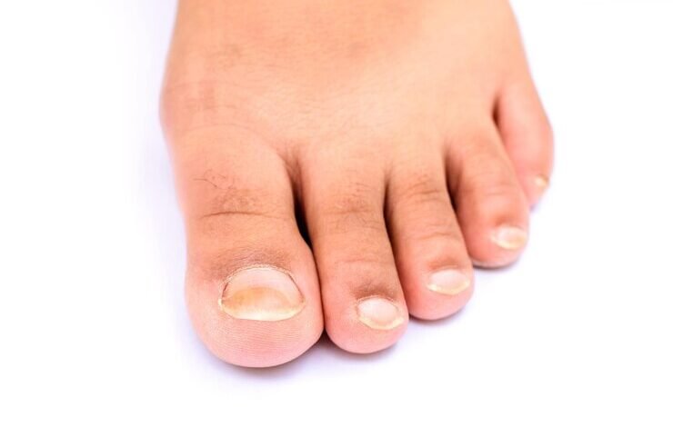 podiatrist and ingrown toenail