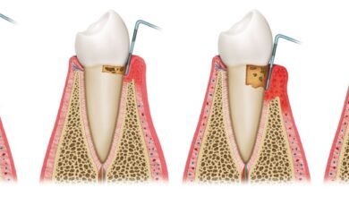 periodontal disease