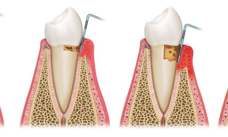 periodontal disease