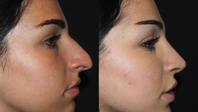 Finding the Best Doctors in Dubai for Rhinoplasty: Top Surgeons Revealed