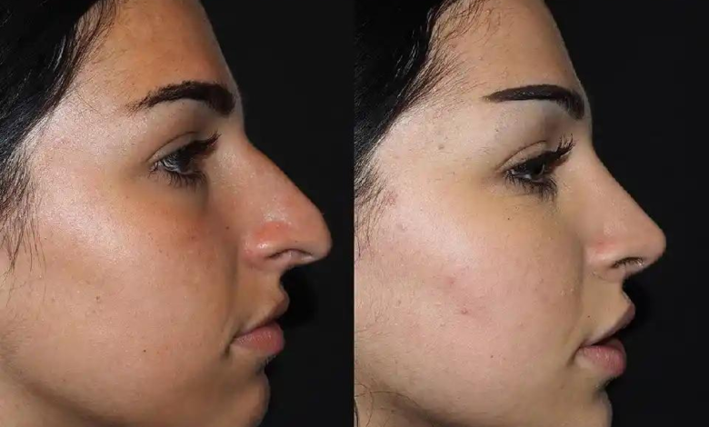 Finding the Best Doctors in Dubai for Rhinoplasty: Top Surgeons Revealed