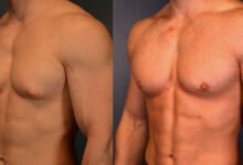 gynecomastia surgery in dubai