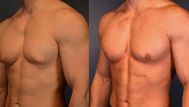 gynecomastia surgery in dubai