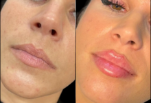 Juvederm in dubai