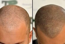 scalp micro pigmentation Treatments