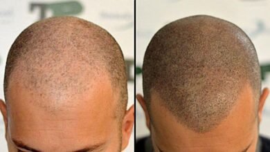 scalp micro pigmentation Treatments