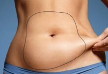 Liposuction in Dubai