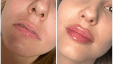 Juvederm