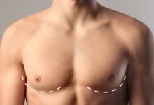 gynecomastia in dubai