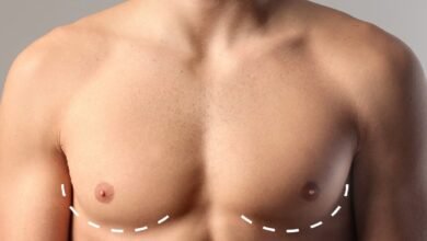 gynecomastia in dubai