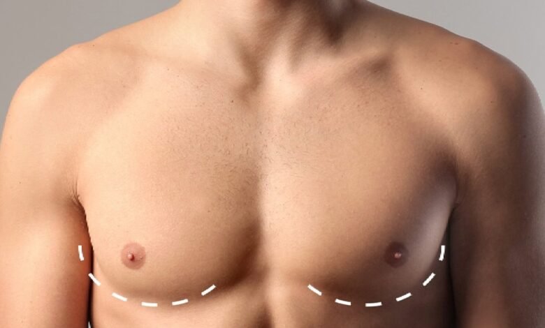 gynecomastia in dubai