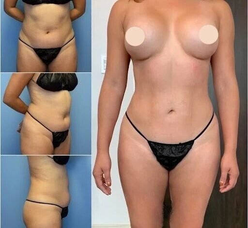 Body Contouring Surgery in dubai