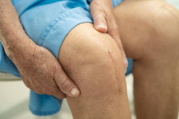 total knee replacement surgery