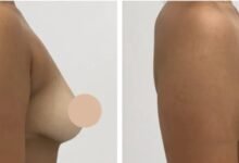 breast lift in dubai