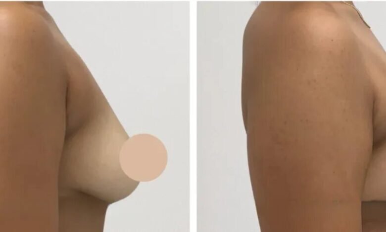 breast lift in dubai