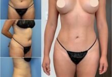 body contouring