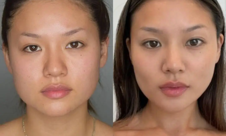 Buccal Fat Removal
