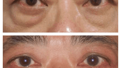 Eye Bag Removal