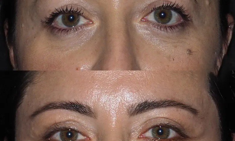 Eye Bag Removal