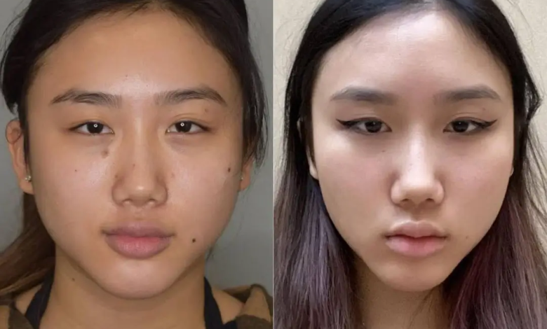 Buccal Fat Removal