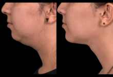 Double chin removal