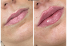 Juvederm