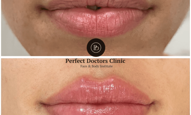 Juvederm