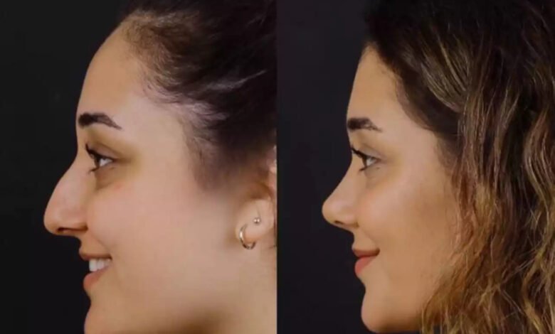 septoplasty in Dubai