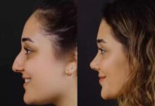 septoplasty in dubai