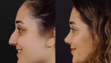 septoplasty in dubai