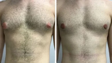 Hormonal Causes Gynecomastia in Dubai