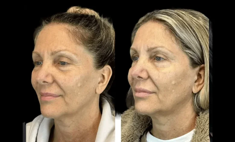 Botox in dubai