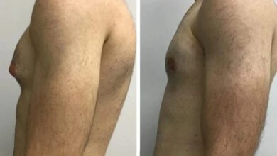 gynecomastia in dubai
