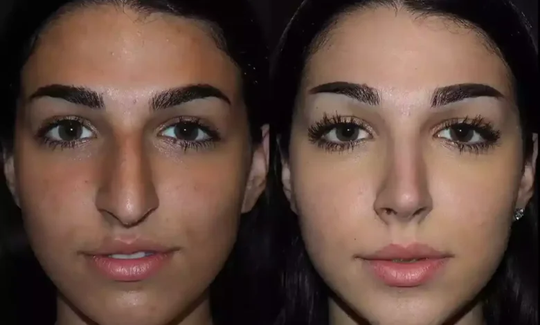 rhinoplasty in Dubai