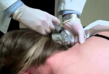 Trigger Point Injections