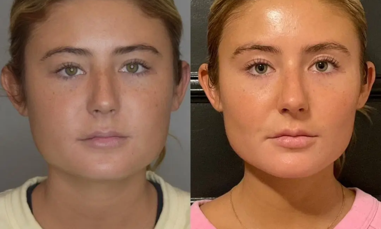 Buccal Fat Removal