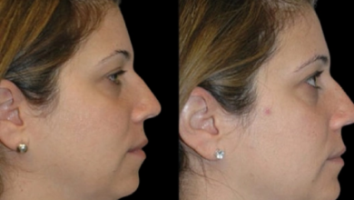 Double chin removal