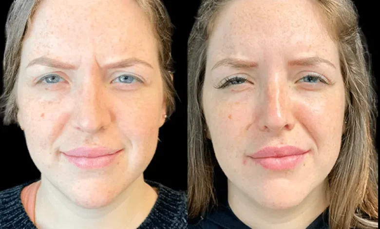 Botox in dubai
