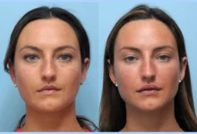 Facial Contouring with the Best Plastic Surgeon in Dubai for Thread Lift
